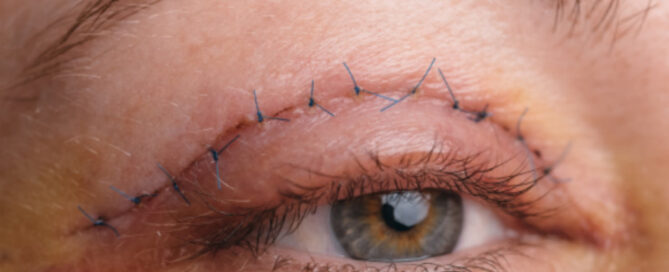 Eyelid Surgery