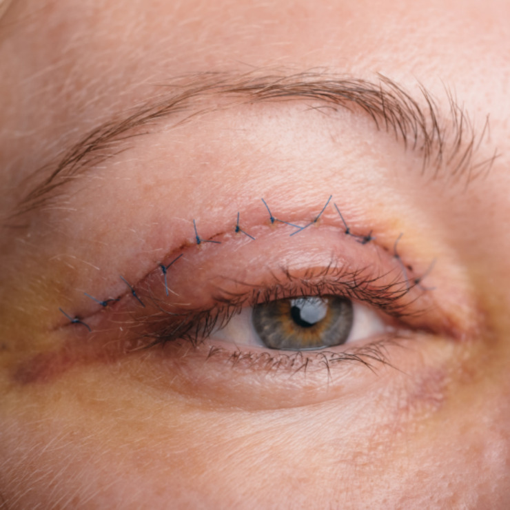 Eyelid Surgery